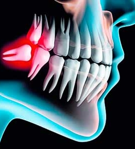 Cirugía de 3eros molares (cordales)