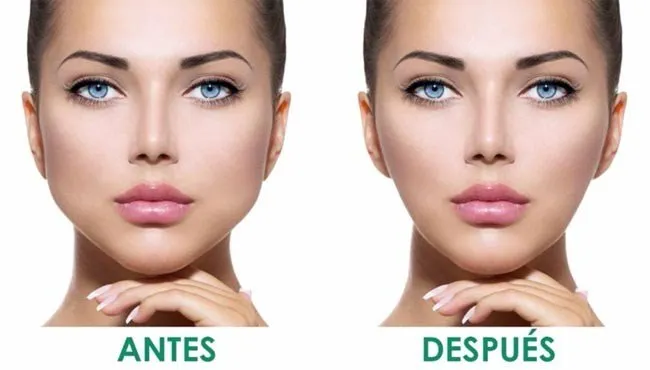 Armonización Orofacial Bichectomía