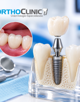 Implante dental y corona sobre implante