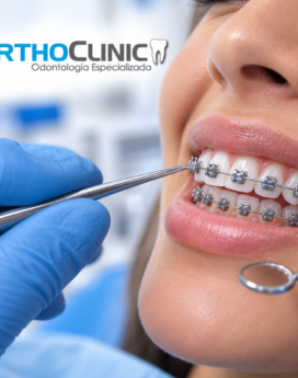 Instalación de brackets convencionales (Breizers)