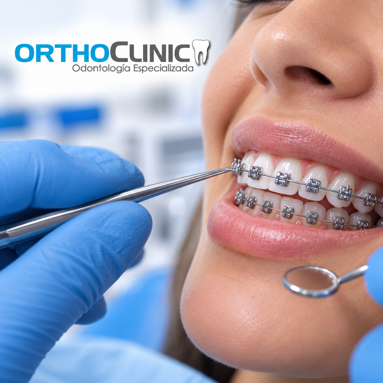 Instalación de brackets convencionales (Breizers)
