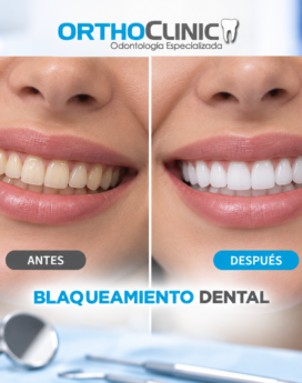 Blaqueamiento dental